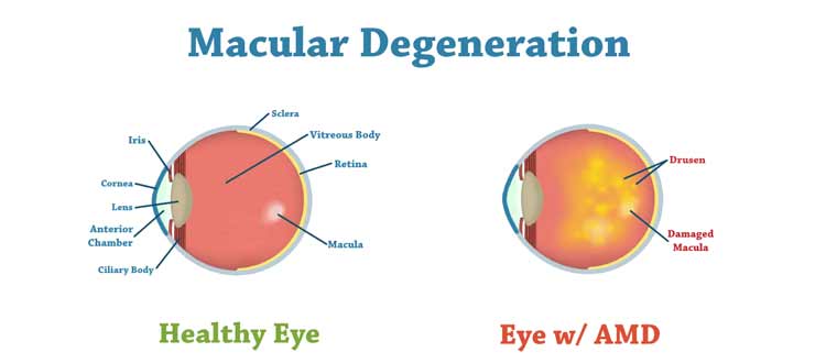 macular degeneration