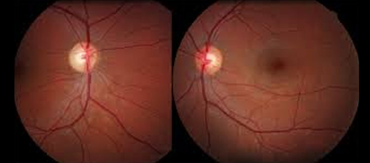 optic nerve atrophy