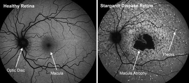 Stargardt Disease Treatment in India