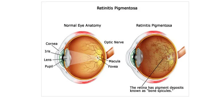 Retinitis Pigmentosa