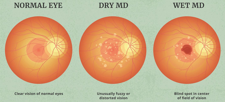 mecular degeneration