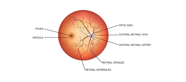 optic atrophy