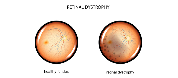 rode & cone dystrophy