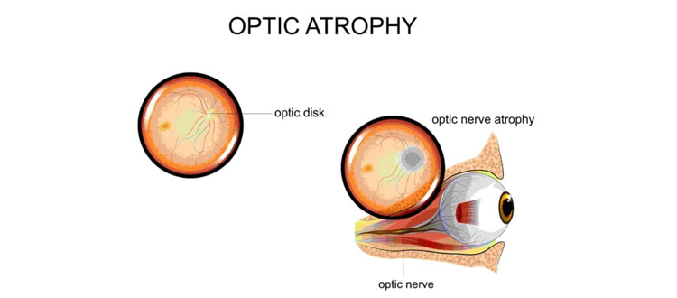 optic atrophy