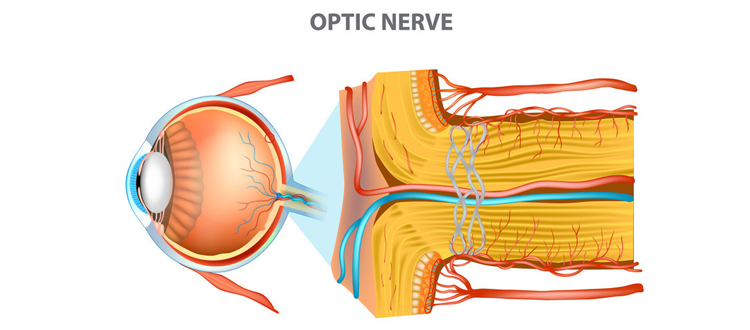 optic atrophy