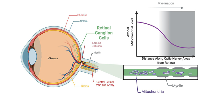 optic atrophy