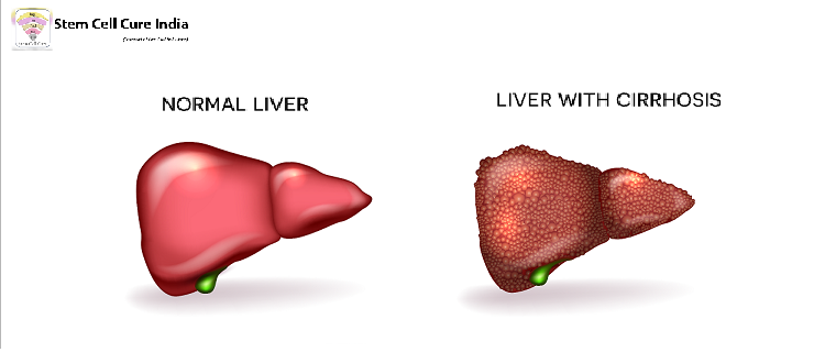 stem cell therapy for liver cirhosis
