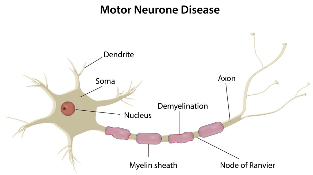 Motor Neurone Disease