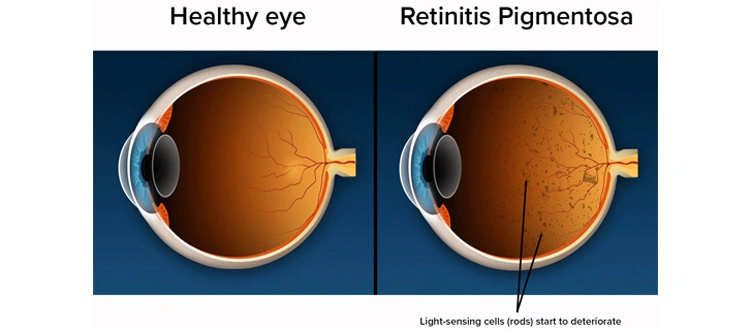 retinitis-pigmentosa