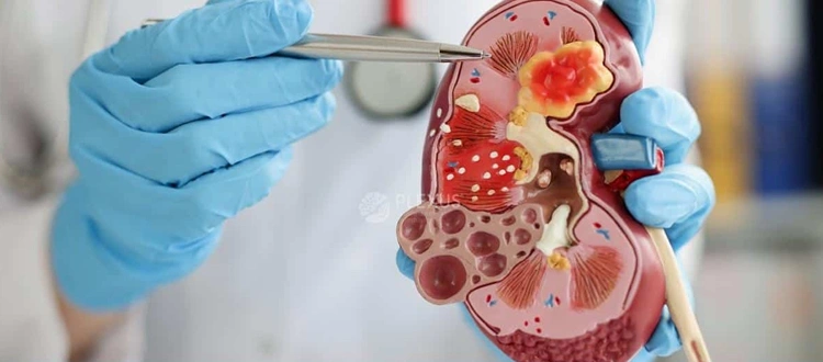 stem-cell-treatment-for-kidney-failure-in-india